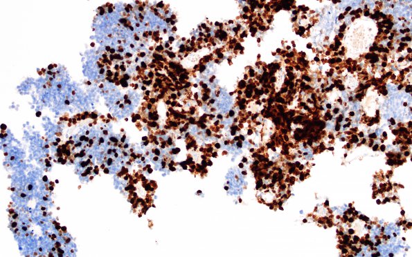 7F Pineoblastoma (Case 7) Ki67 40X 2