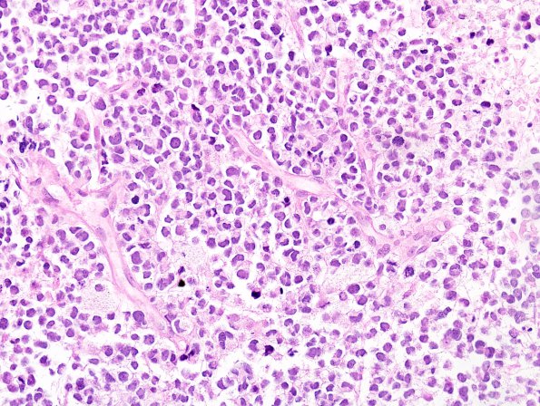 8A2 Pineoblastoma (Case 8) H&E 2