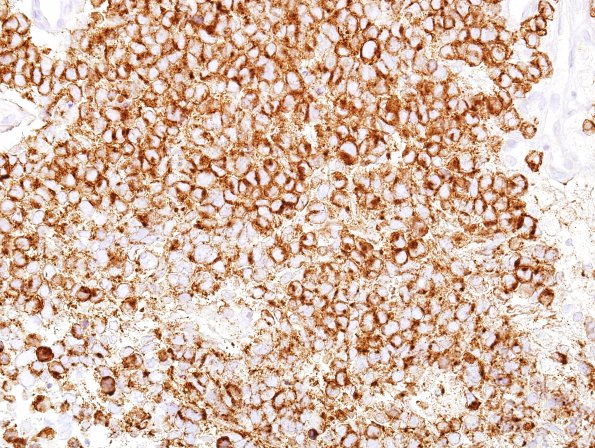 8B2 Pineoblastoma (Case 8) SYN 1