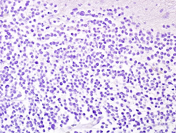 8C Pineoblastoma (Case 8) Pan-CK 1