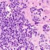 9A3 Pineoblastoma Gangliocytic (Case 9) E