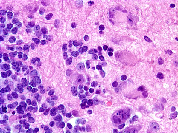 9A4 Pineoblastoma Gangliocytic (Case 9) D