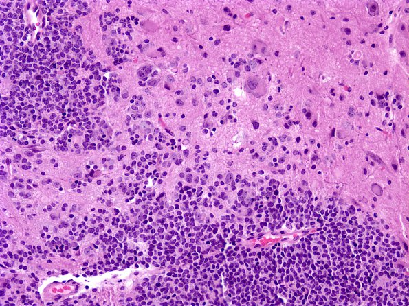 9A5 Pineoblastoma Gangliocytic (Case 9) F