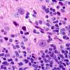 9A6 Pineoblastoma Gangliocytic (Case 9) C