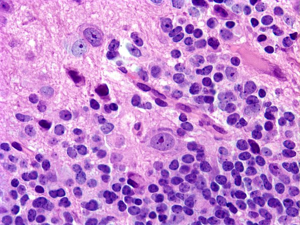 9A6 Pineoblastoma Gangliocytic (Case 9) C