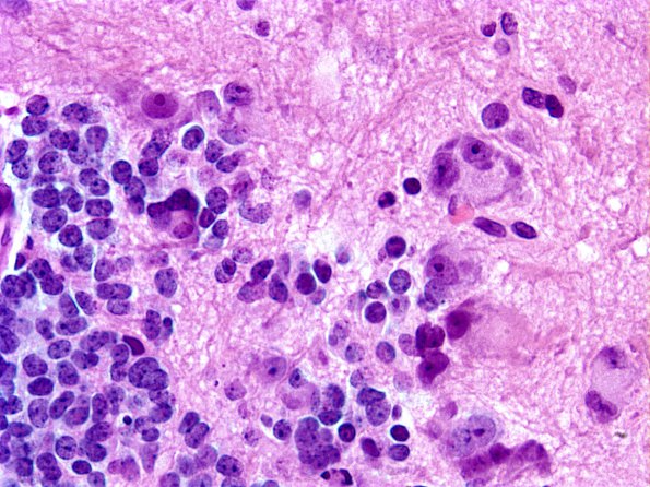 9A7 Pineoblastoma Gangliocytic (Case 9) B