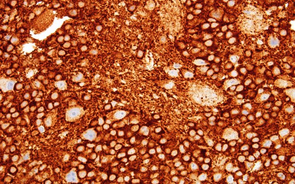 9B3 Pineoblastoma Gangliocytic (Case 9) SYN 60X