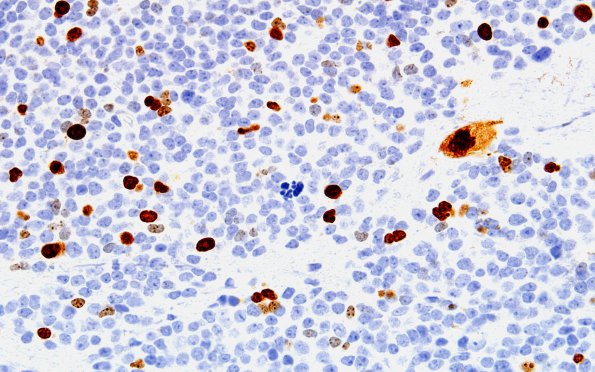 9C1 Pineoblastoma Gangliocytic (Case 9) Ki67 60X