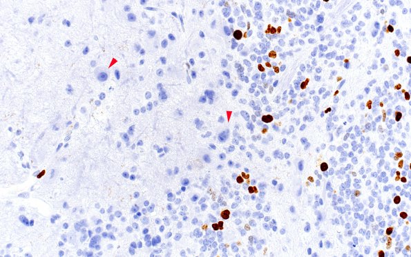 9C2 Pineoblastoma Gangliocytic (Case 9) Ki67 40X copy