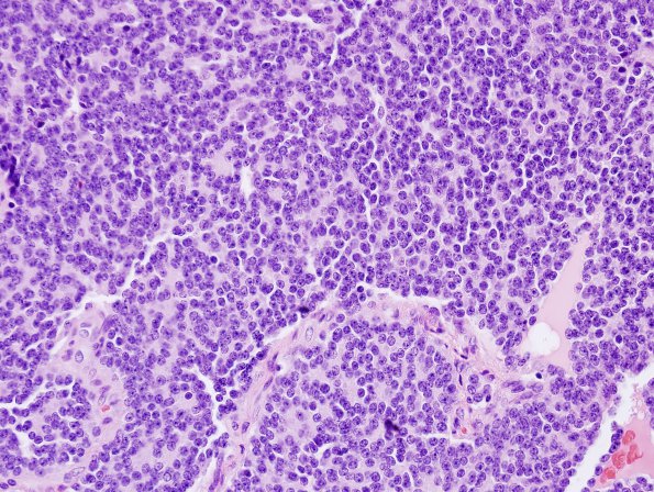 10A1 Pineocytoma (Case 10) H&E 1.jpg