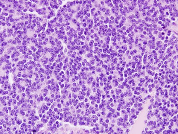 10A3 Pineocytoma (Case 10) H&E 5.jpg