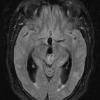 11A Pineocytoma, pleomorphic variant (Case 11) FLAIR A - Copy