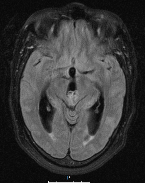 11A Pineocytoma, pleomorphic variant (Case 11) FLAIR A - Copy