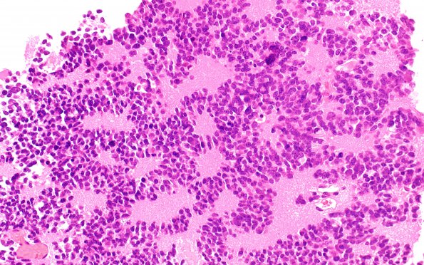 11B1 Pineocytoma, pleomorphic variant (Case 11) H&E 1