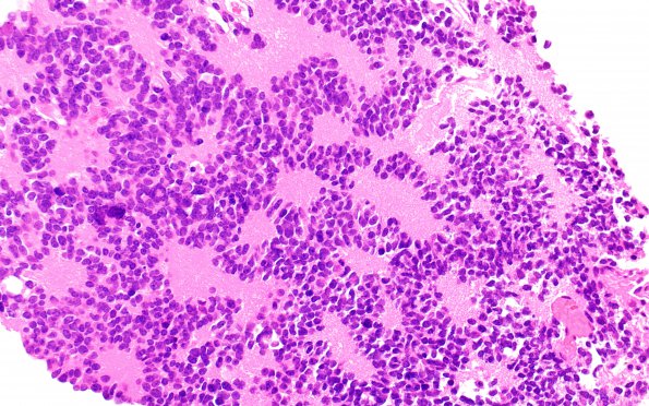 11B3 Pineocytoma, pleomorphic variant (Case 11) H&E 7