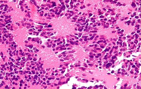 11B4 Pineocytoma, pleomorphic variant (Case 11) H&E 60X