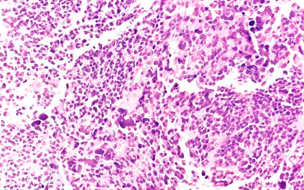 11B5 Pineocytoma, pleomorphic variant (Case 11) H&E 40X (2)