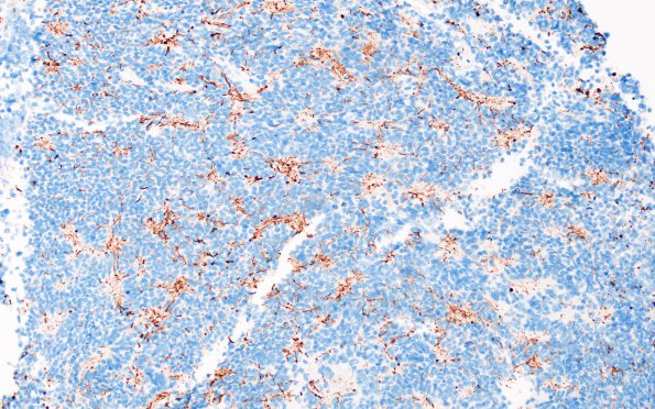 11C1 Pineocytoma, pleomorphic variant (Case 11) NF 5