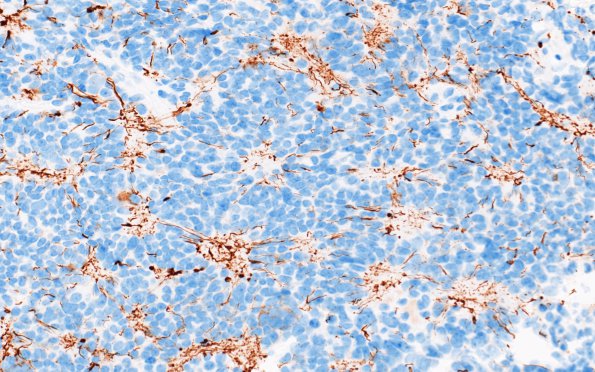 11C2 Pineocytoma, pleomorphic variant (Case 11) NF 4