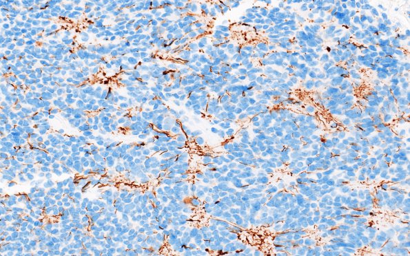 11C3 Pineocytoma, pleomorphic variant (Case 11) NF 3