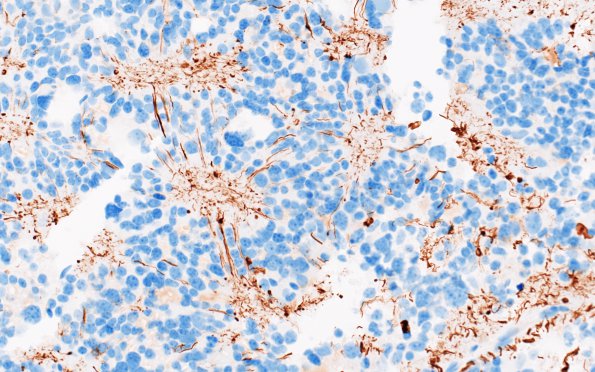 11C4 Pineocytoma, pleomorphic variant (Case 11) NF 1