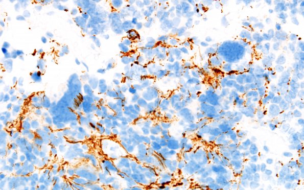 11C5 Pineocytoma, pleomorphic variant (Case 11) NF 60X1