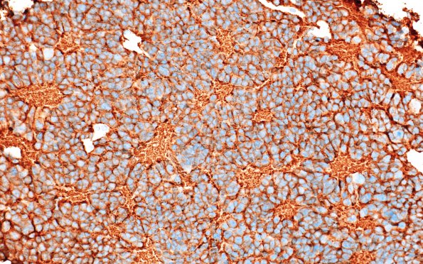 11D1 Pineocytoma, pleomorphic variant (Case 11) SYN 5