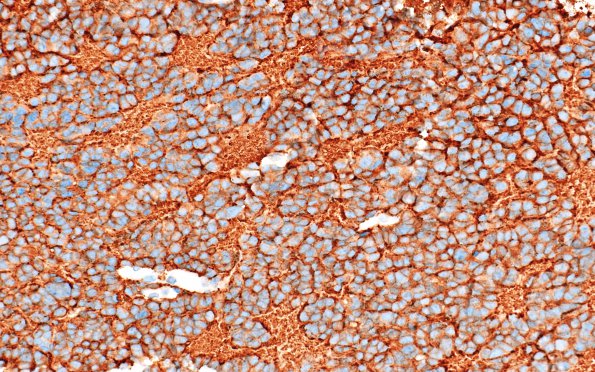 11D2 Pineocytoma, pleomorphic variant (Case 11) SYN 7