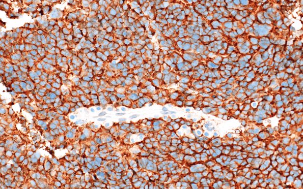 11D4 Pineocytoma, pleomorphic variant (Case 11) SYN 6