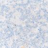 11E Pineocytoma, pleomorphic variant (Case 11) Ki67 20X 1