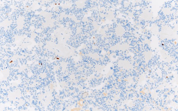 11E Pineocytoma, pleomorphic variant (Case 11) Ki67 20X 1