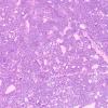 12A1 Pineocytoma (AFIP 1965 Study Set Slide 79) H&E 4X