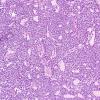 12A2 Pineocytoma (AFIP 1965 Study Set Slide 79) H&E.jpg