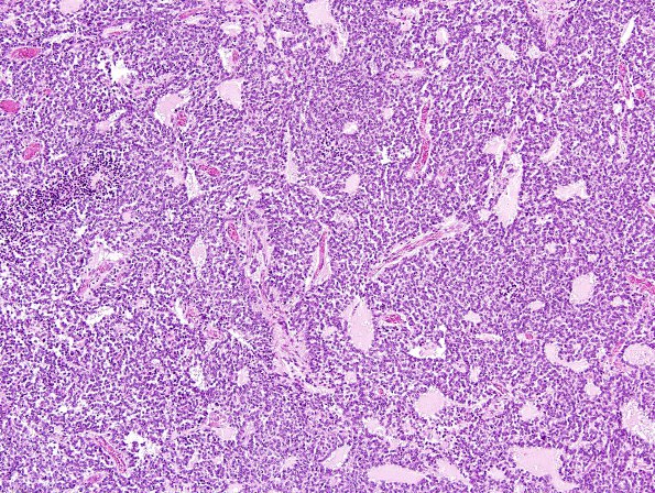 12A2 Pineocytoma (AFIP 1965 Study Set Slide 79) H&E.jpg