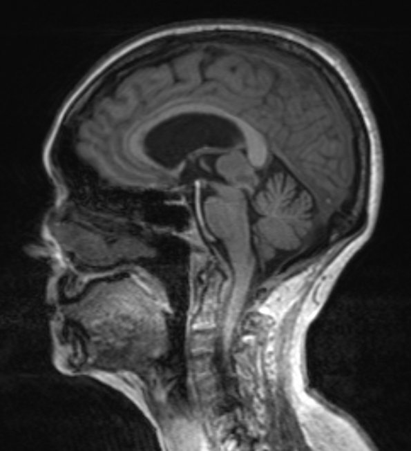 1A1 Pineocytoma (Case 1) T1 MPRAGE 2 - Copy