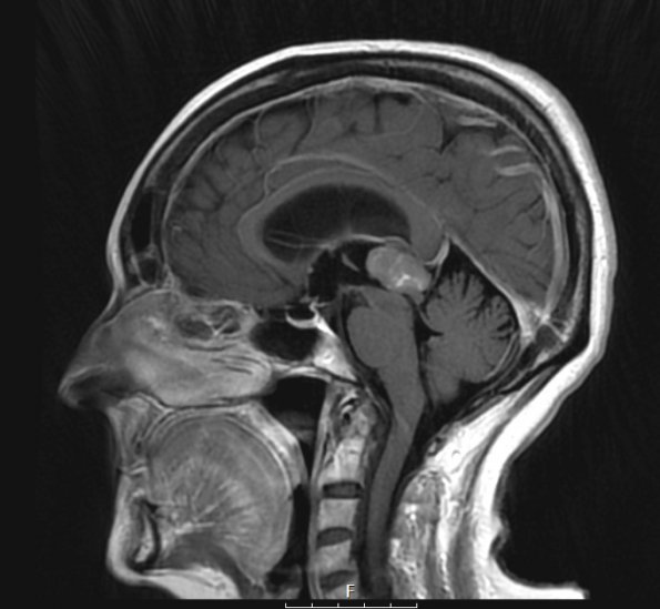 1A2 Pineocytoma (Case 1) T1W - Copy