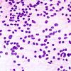 1B1 Pineocytoma (Case 1) H&E smear 1.jpg