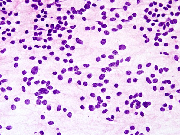 1B1 Pineocytoma (Case 1) H&E smear 1.jpg