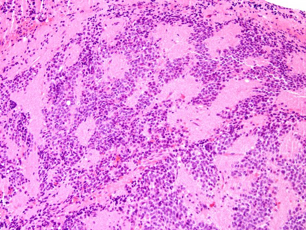 1B2 Pineocytoma (Case 1) H&E 3.jpg