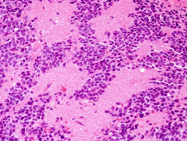 1B3 Pineocytoma (Case 1) H&E 4.jpg