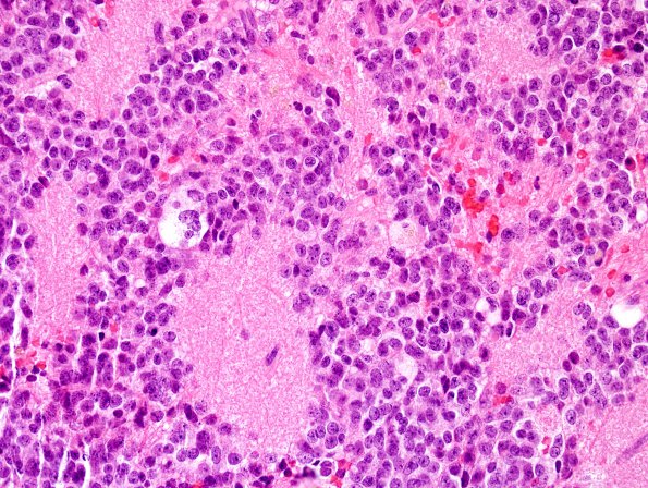 1B4 Pineocytoma (Case 1) H&E 6.jpg