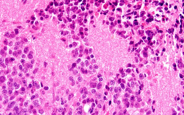 1B5 Pineocytoma (Case 1) H&E 60X