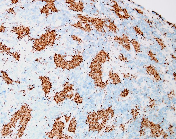 1C1 Pineocytoma (Case 1) NF 7.jpg