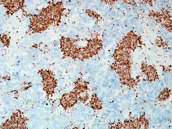 1C2 Pineocytoma (Case 1) NF 1.jpg