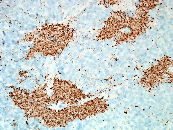 1C3 Pineocytoma (Case 1) NF 6.jpg