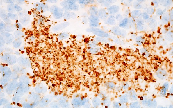 1C4 Pineocytoma (Case 1) NF 100X