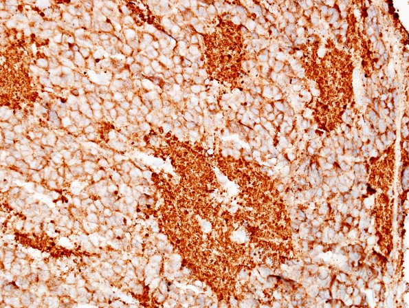 1D2 Pineocytoma (Case 1) SYN 1.jpg