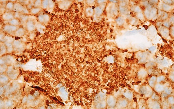 1D4 Pineocytoma (Case 1) SYN 100X