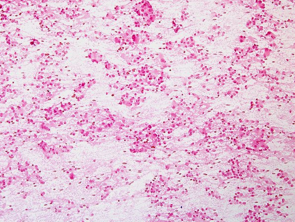 2B1 Pineocytoma (Case 2) H&E smear 2.jpg