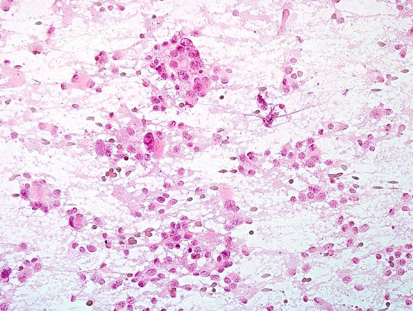 2B2 Pineocytoma (Case 2) H&E smear 1.jpg